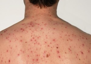 Allarme morbillo, un contagiato al concorso per magistratura a Roma. Bassetti: Si rischia un'epidemia