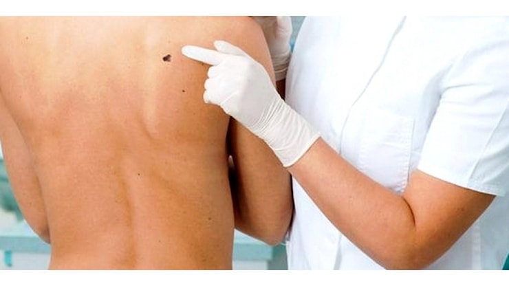 Policlinico Messina, il 23 maggio visite gratuite per melanoma in dermatologia - Gazzetta del Sud