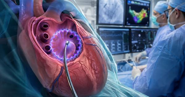 Fibrillazione atriale, ad Ancona il cuore torna a ritmo con impulsi ultrarapidi